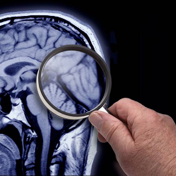 Eine Aufnahme aus einem MRT zeigt die Alzheimer-Region im Gehirn.