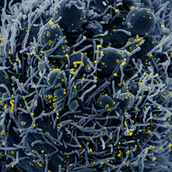 Auf dieser vom US-Forschungszentrum «National Institute of Allergy and Infectious Diseases» (NIAID) zur Verfügung gestellten Aufnahme ist eine Zelle (blau) mit dem Coronavirus infiziert. (Symbolbild)
