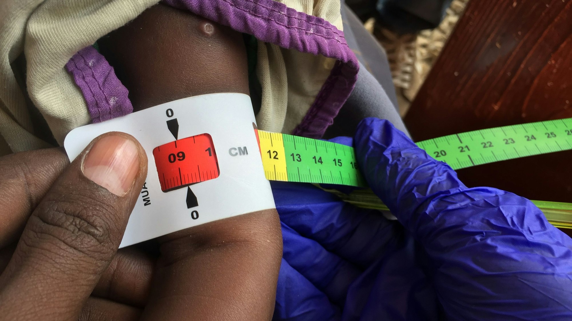 Ein Arzt misst den Armumfang eines Babys in einer Klinik.