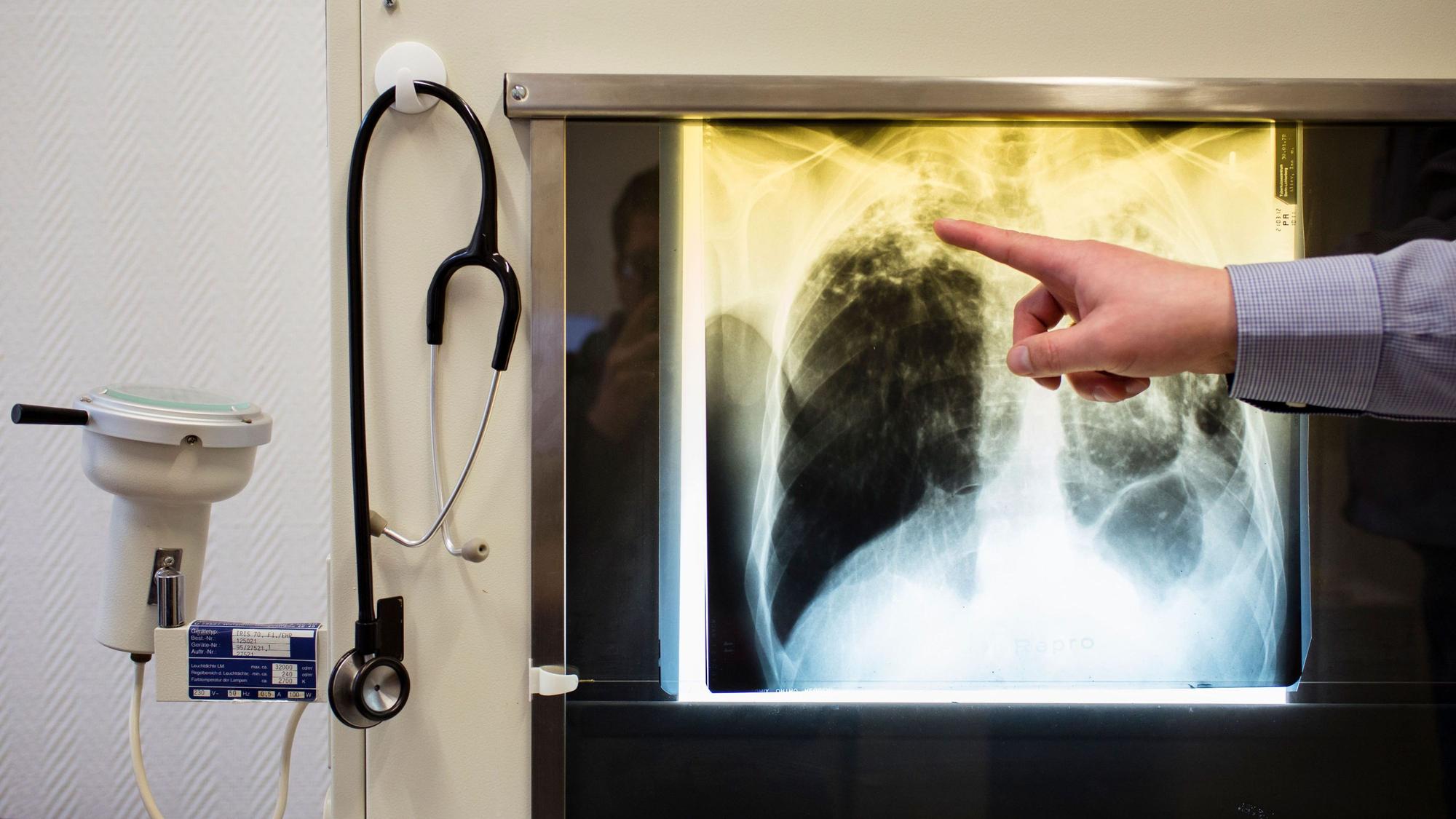 Ein Arzt zeigt einen Tuberkulose-Fall anhand eines Röntgenbildes in seinem Büro im Tuberkulosezentrum.