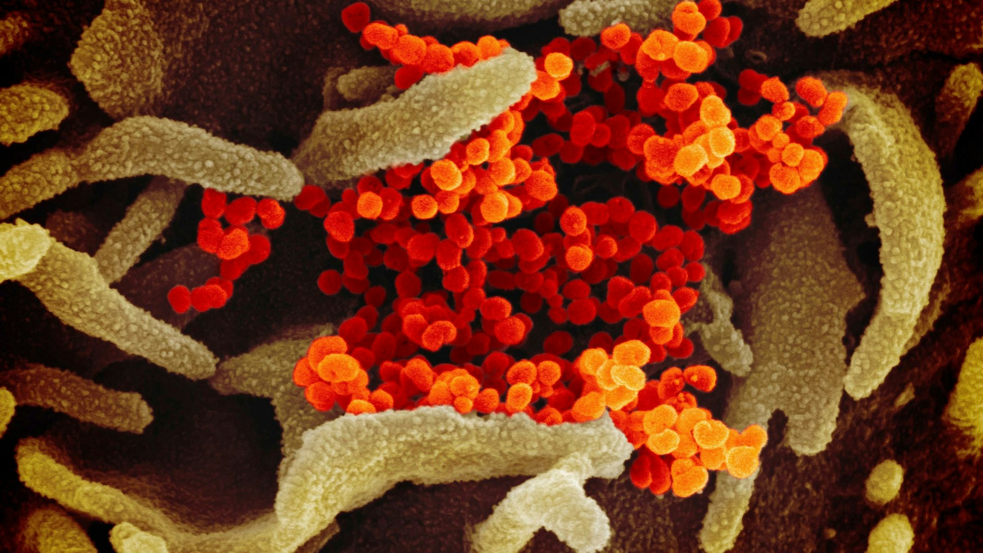 Eine elektronenmikroskopische Aufnahme von SARS-CoV-2