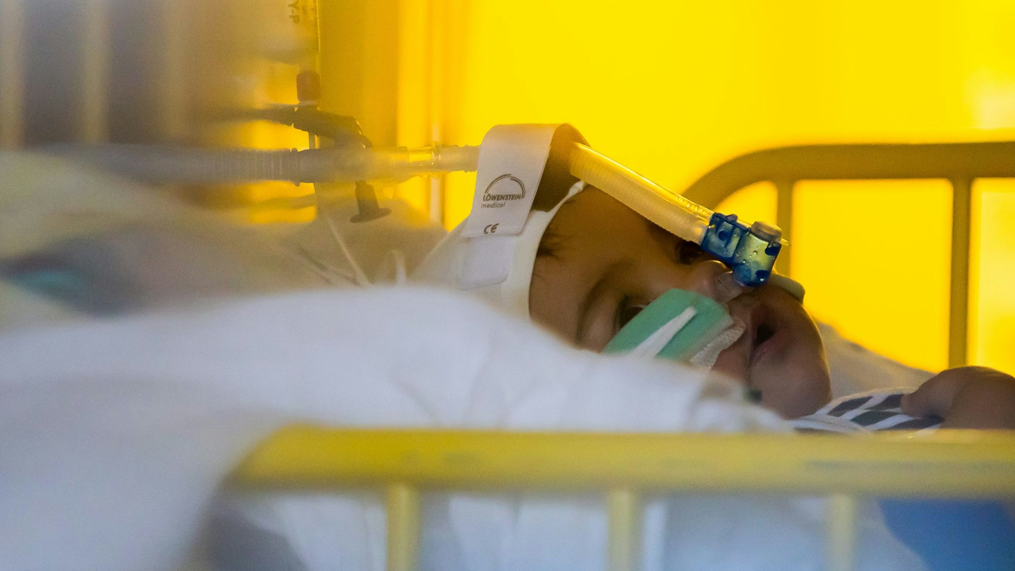 Ein Kind liegt in einem Krankenhausbett mit Schlauch im Gesicht.