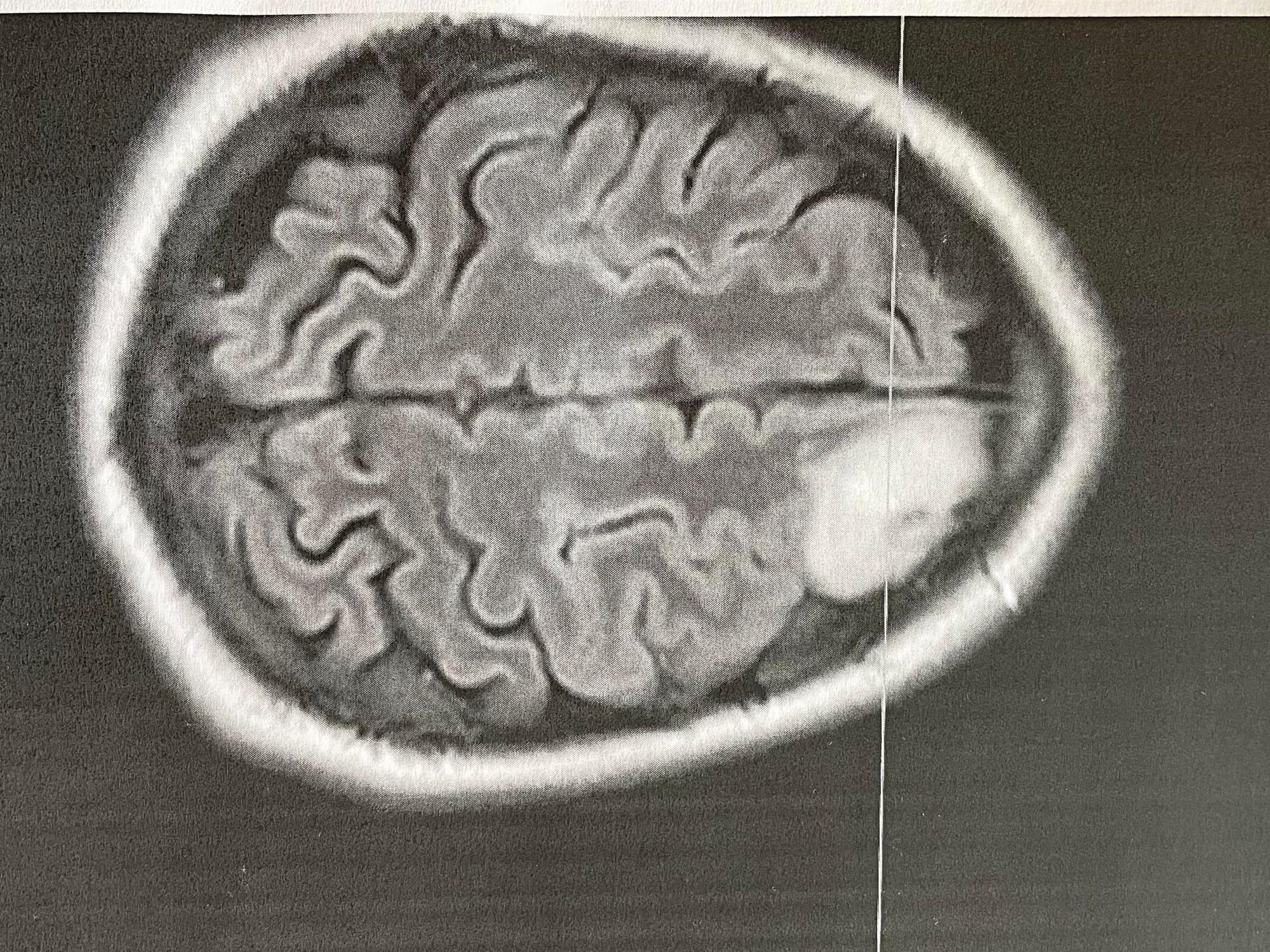 Eine Querschnittsaufnahme des Gehirns zeigt den mandarinengroßen Tumor (rechts, weiß)