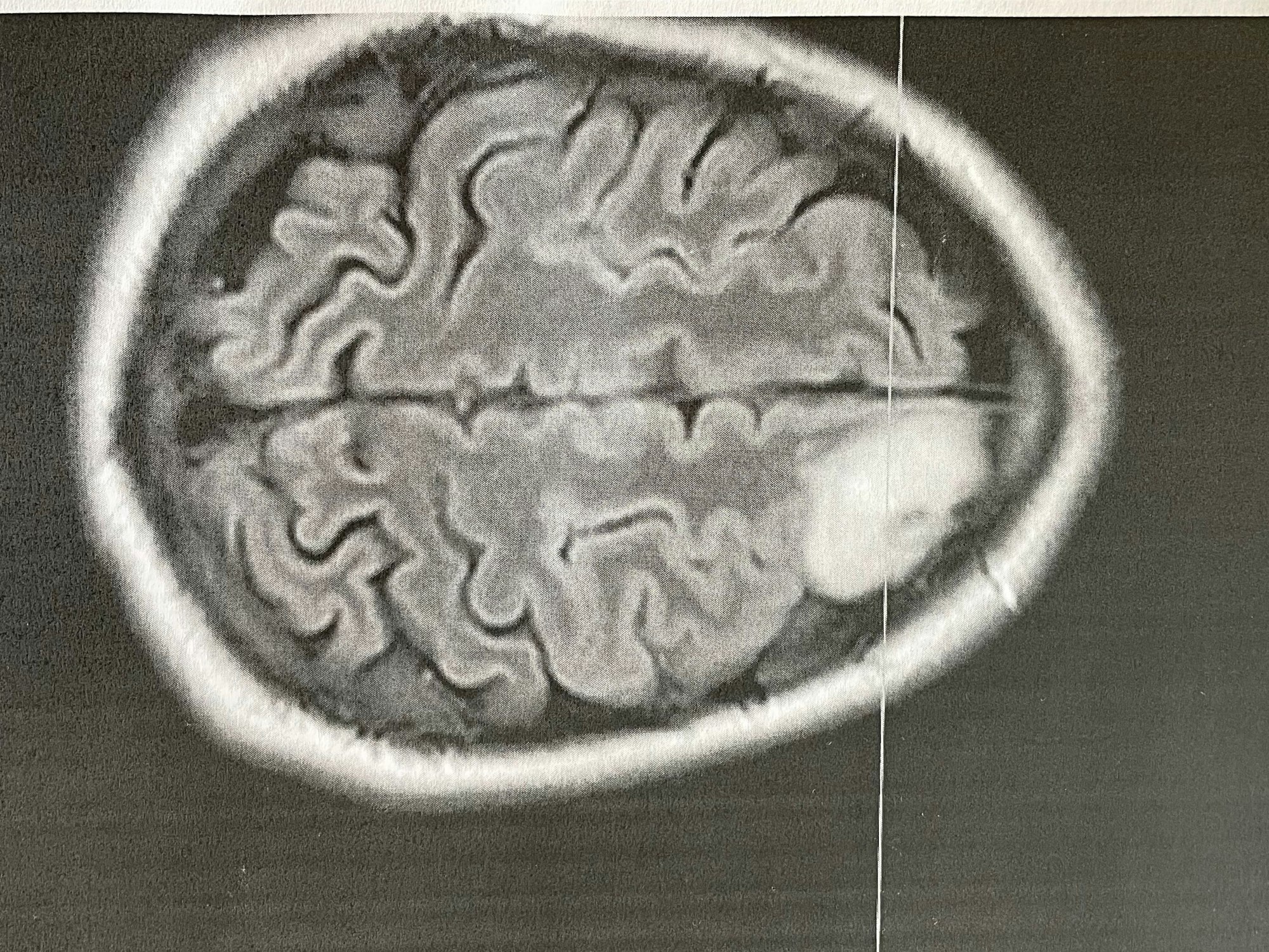 Eine Querschnittsaufnahme des Gehirns zeigt den mandarinengroßen Tumor (rechts, weiß)