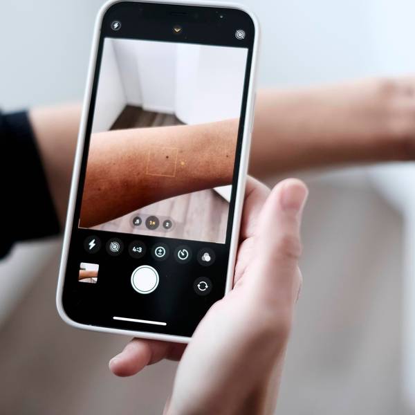 KI in der Dermatologie: Eine Frau fotografiert mit einem Handy die Haut auf ihrem Arm ab.