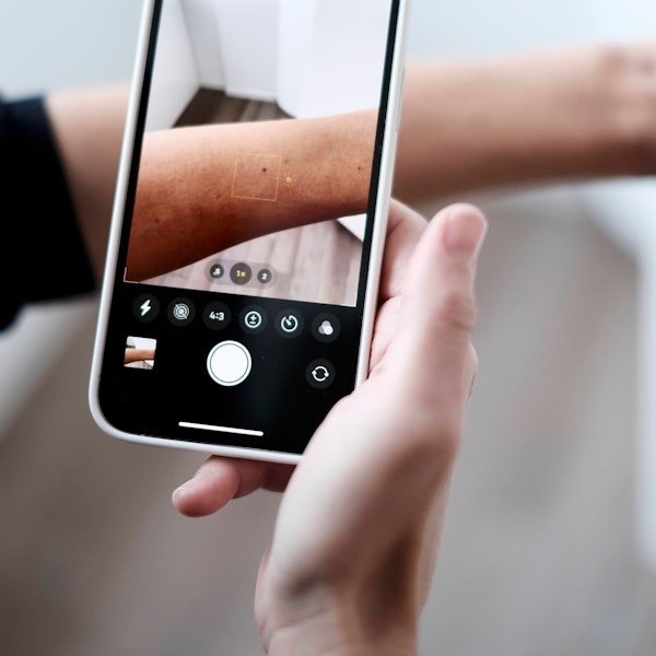 KI in der Dermatologie: Eine Frau fotografiert mit einem Handy die Haut auf ihrem Arm ab.