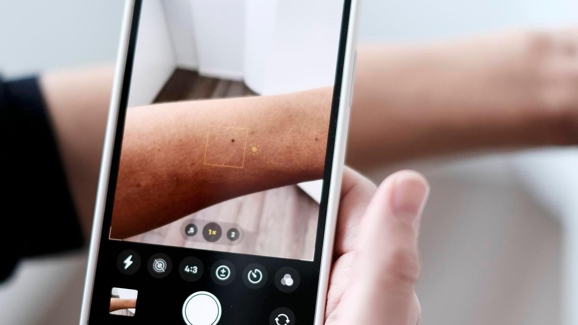 KI in der Dermatologie: Eine Frau fotografiert mit einem Handy die Haut auf ihrem Arm ab.