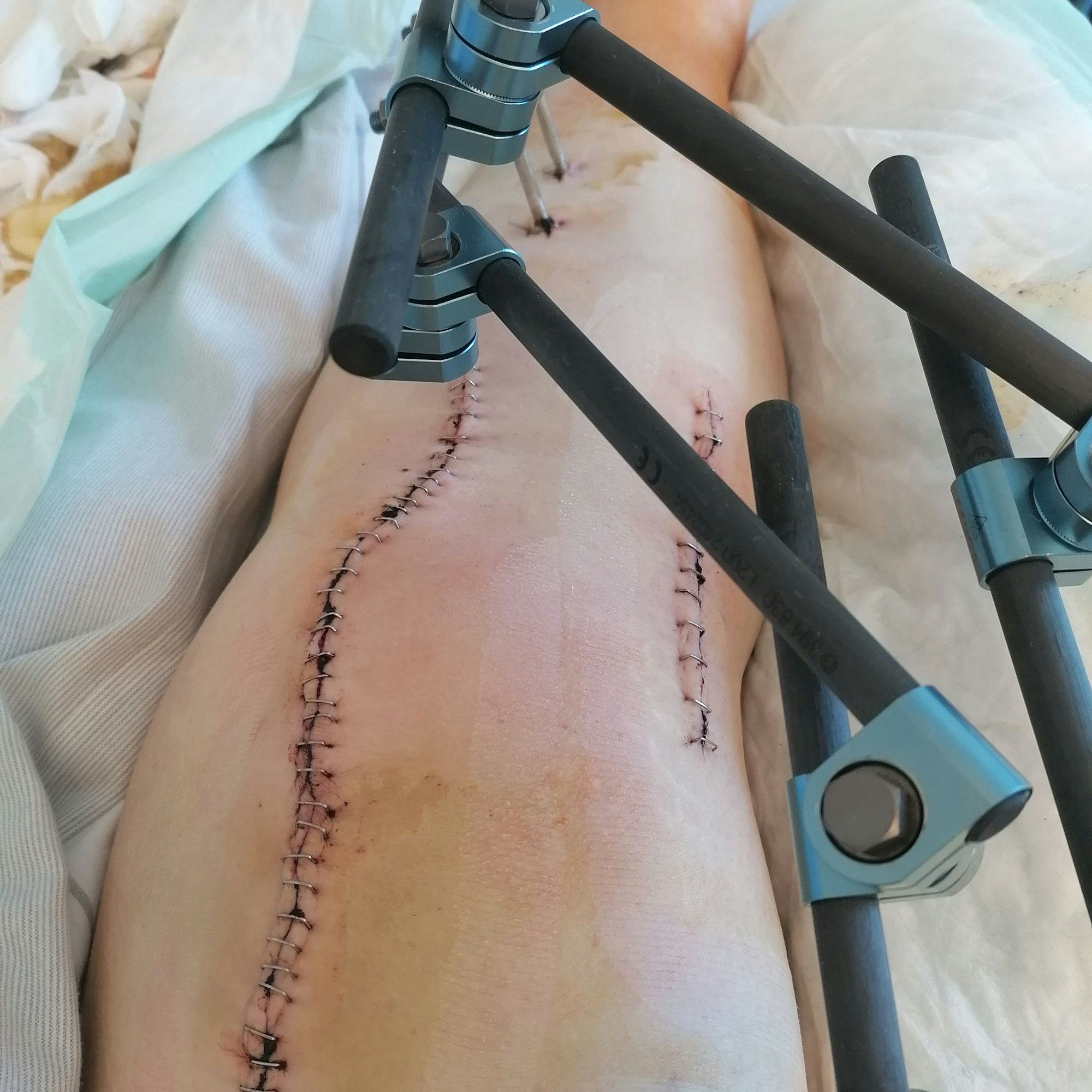 Operiertes Bein mit Fixatoren und zwei großen Narben