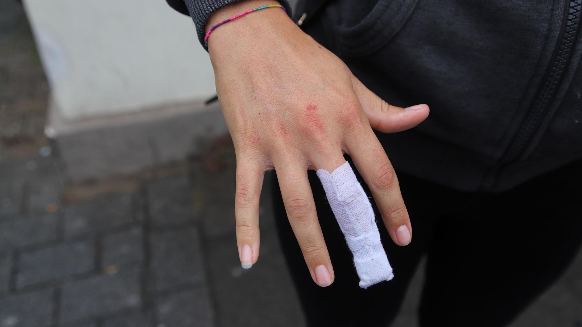 Julia Reich hält ihren lädierten Finger in die Kamera, wo sie von dem Rottweiler gebissen wurde.