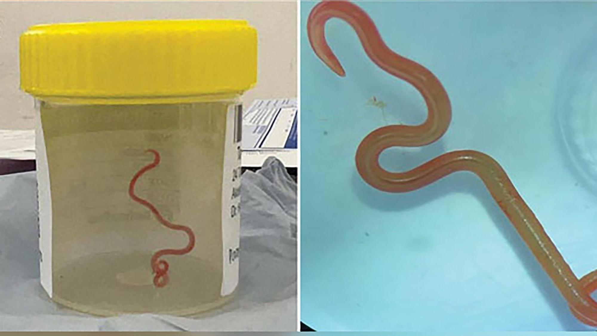 Das undatiertes Bild zeigt einen lebenden Spulwurm "Ophidascaris robertsi", der im Gehirn einer 64-jährigen Australierin gefunden wurde. In einem Krankenhaus in Canberra haben Ärzte einen lebendigen, acht Zentimeter langen Rundwurm aus dem Gehirn einer 64-jährigen Frau entfernt. Bei dem Parasiten handele es sich um die Spezies Ophidascaris robertsi, die normalerweise nur in Pythons vorkomme.