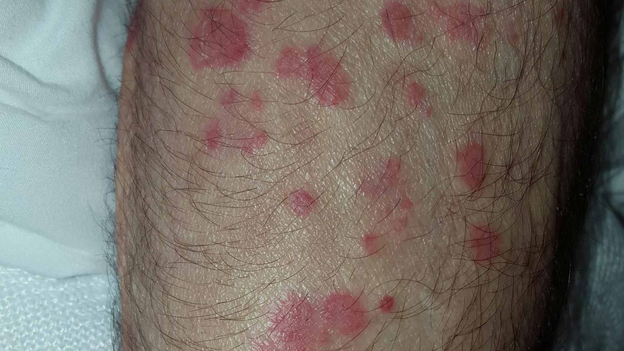 Bei Infizierten führt die Kokzidioidomykose oft zu Läsionen der Haut. Der Pilz kann sich jedoch ohne Behandlung auch im Nervensystem und dem Gehirn ausbreiten. (Archivbild)