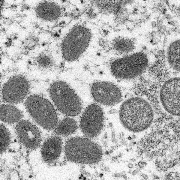 Infektionskrankheit Mpox unter dem Mikroskop: Die vergrößerte Aufnahme zeigt reife, ovale Affenpockenviren (l) und kugelförmige unreife Virionen (r) aus einer menschlichen Hautprobe. (Archivbild)