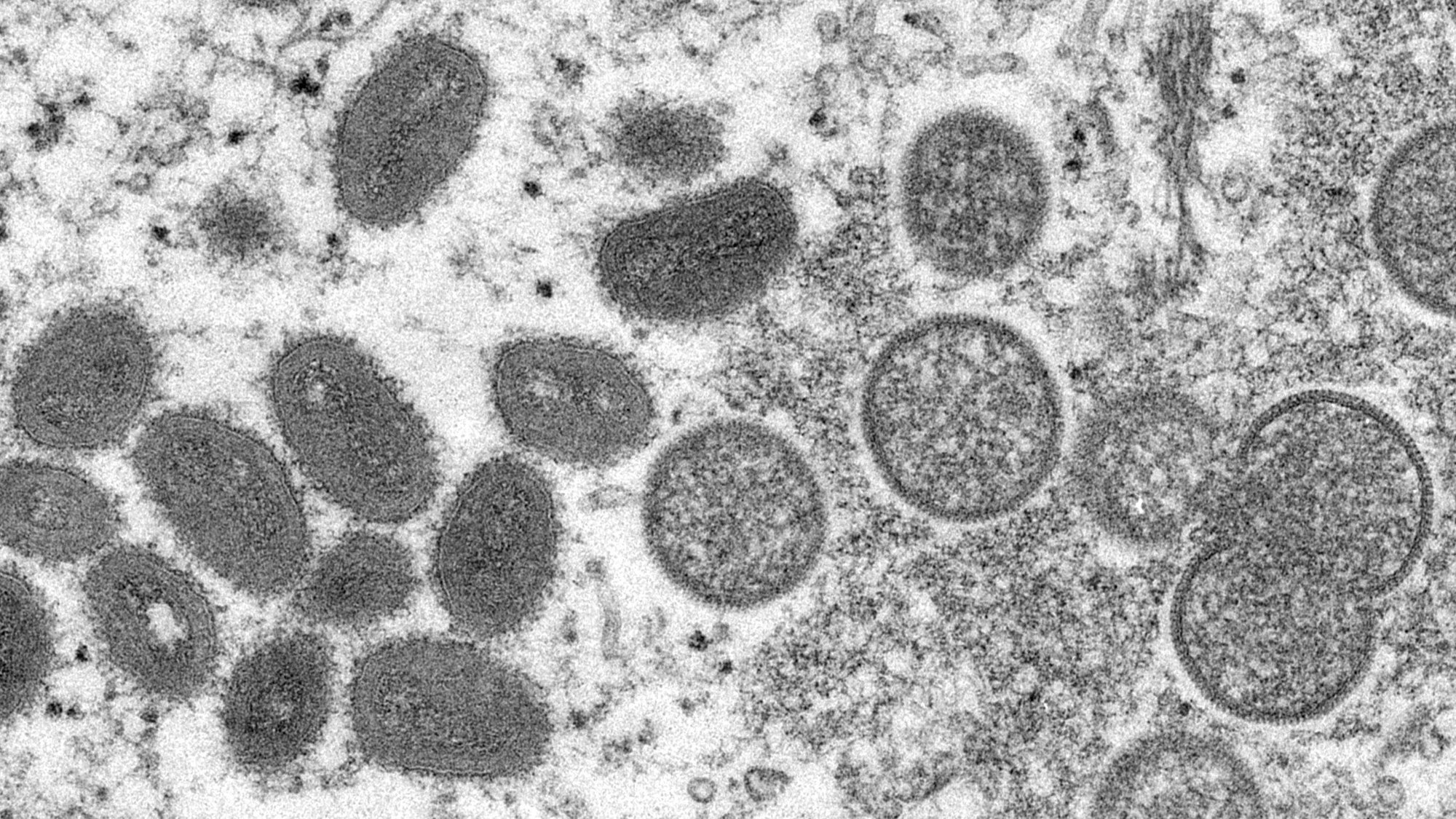 Infektionskrankheit Mpox unter dem Mikroskop: Die vergrößerte Aufnahme zeigt reife, ovale Affenpockenviren (l) und kugelförmige unreife Virionen (r) aus einer menschlichen Hautprobe. (Archivbild)