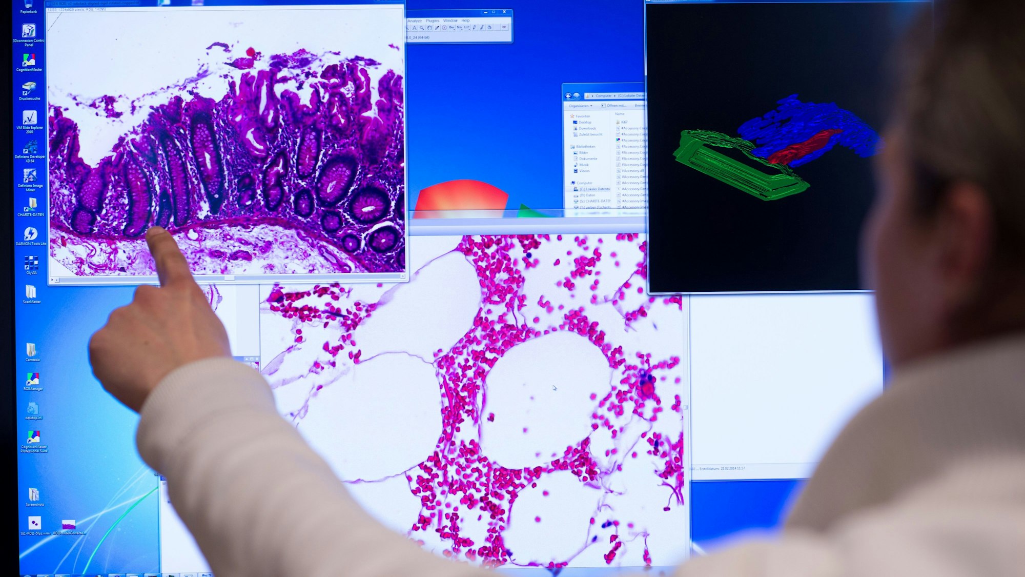 Ein Mitarbeiter zeigt im Institut der Pathologie der Universitätsklinik Charité in Berlin an einem Computerbildschirm auf eine Darstellung einer eingescannten Probe eines Stück Gewebes aus dem Dickdarm, das bei einer Operation entnommenen wurde. (Symbolbild)