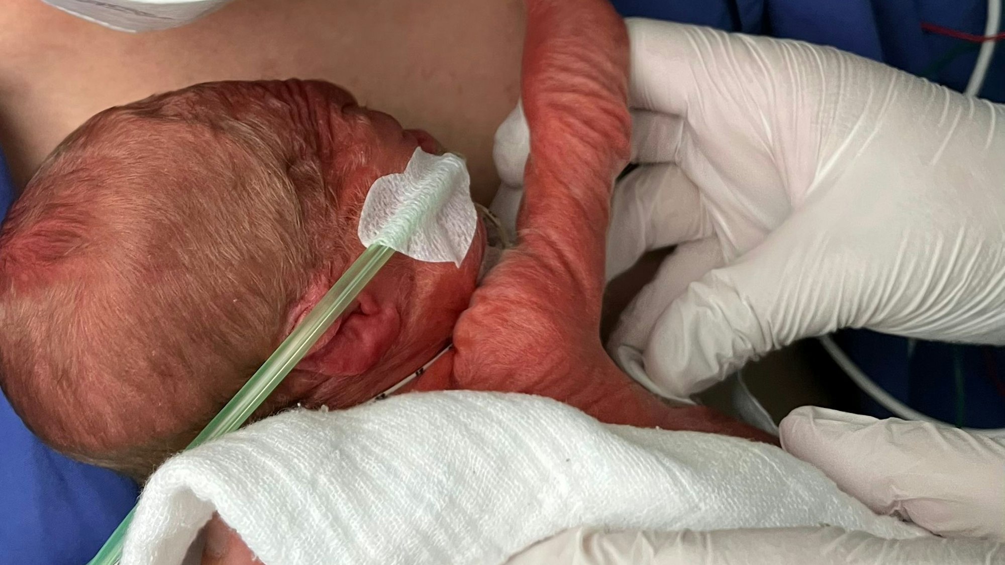 Das Bild zeigt ein kleines Baby, das bei der Geburt gerade einmal 1000 Gramm wiegt.