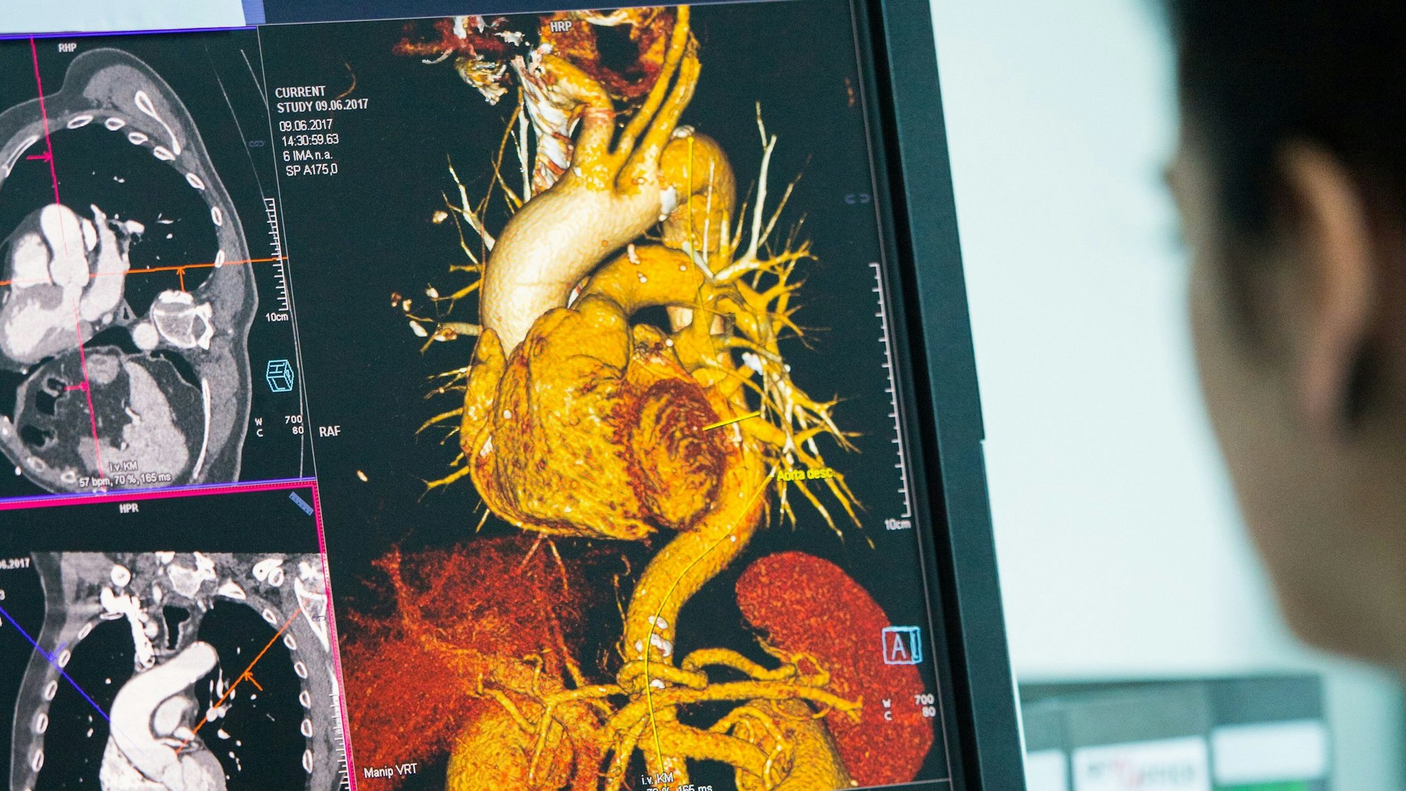 Ein Mitarbeiter sitzt vor einem Monitor, der eine Darstellung der Aorta aus dem Computertomographen (CT) zeigt.