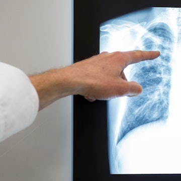 Ein Arzt zeigt im Vivantes Klinikum Neukölln auf das Röntgenbild einer Lunge.