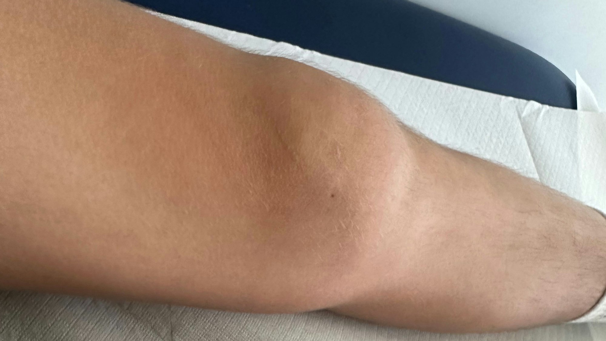 Durch die Entzündung ist das Kniegelenk des Kindes angeschwollen.