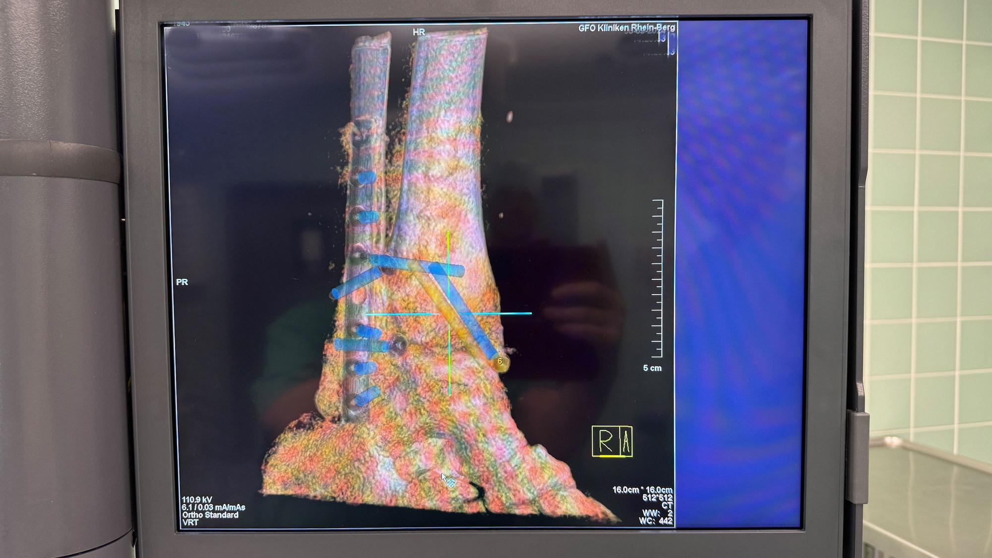 Plastische, farbige Darstellung des operierten Bruchs mit Schrauben und Implantaten.