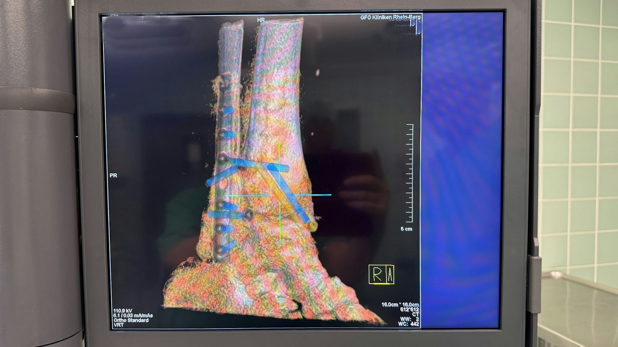 Plastische, farbige Darstellung des operierten Bruchs mit Schrauben und Implantaten.