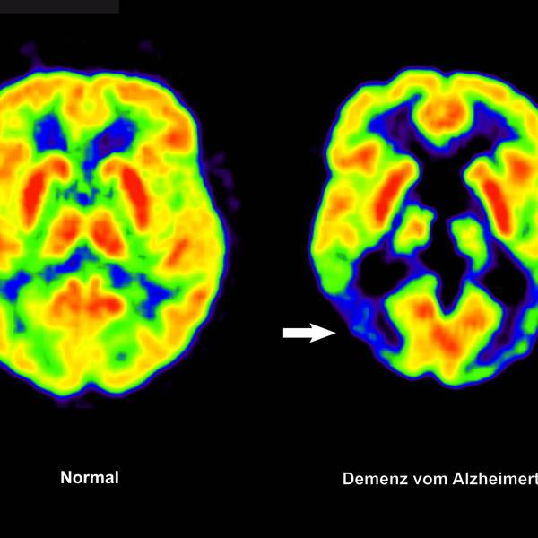 Zwei PET-Abbildungen von Gehirnen sind zu sehen - sie zeigen gelbe, rote, orange und blaue Bereiche.