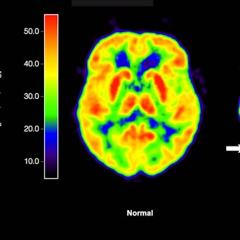 Zwei PET-Abbildungen von Gehirnen sind zu sehen - sie zeigen gelbe, rote, orange und blaue Bereiche.