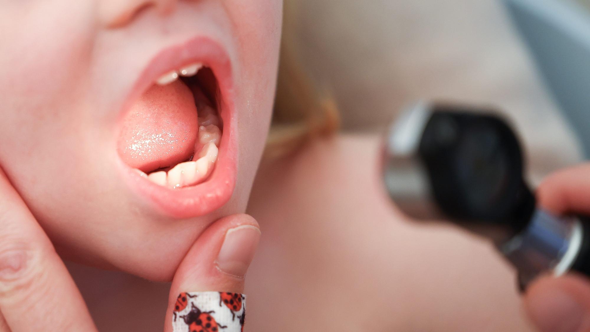 08.12.2022, Hamburg: Mit einem Otoskop untersucht eine Kinderärztin den Mund und Hals eines Mädchens im Rahmen einer U9-Untersuchung.