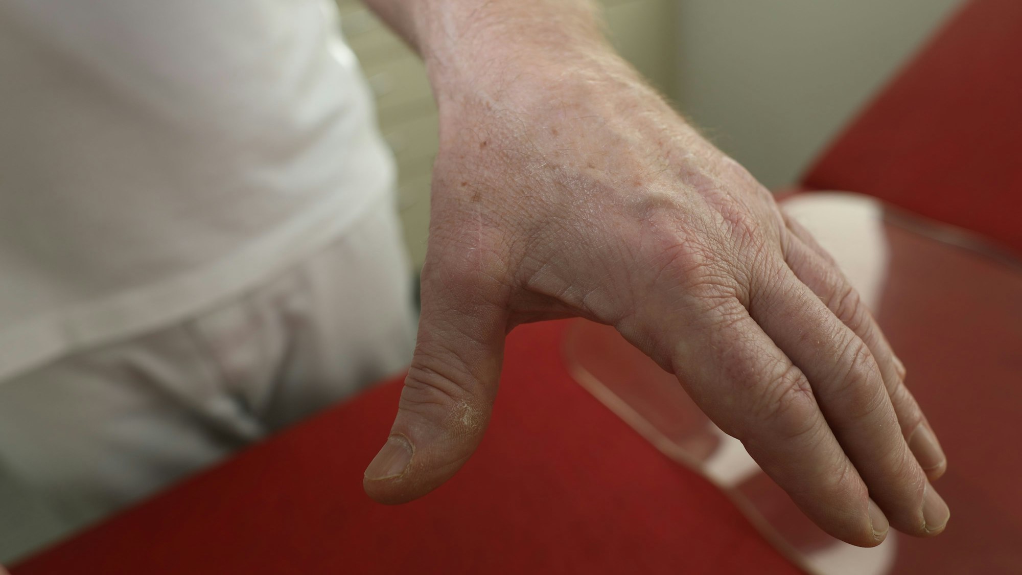 Dr. Rolf-Peter Kuchem zeigt seinen operierten Daumen.