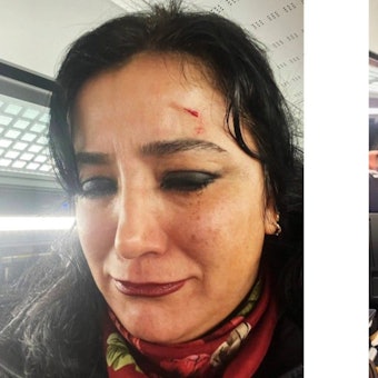 Gökay Akbulut postete im Anschluss Fotos auf ihrem Instagram-Kanal, die ihre Verletzung zeigen.