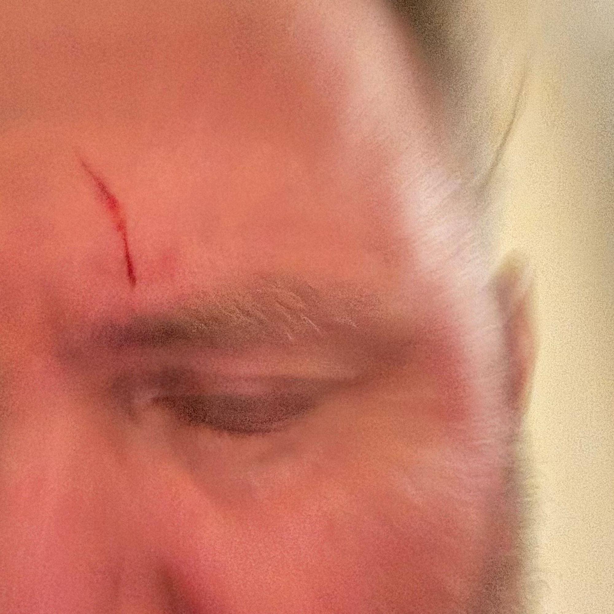 Foto von Stirn mit Wunde und Blut