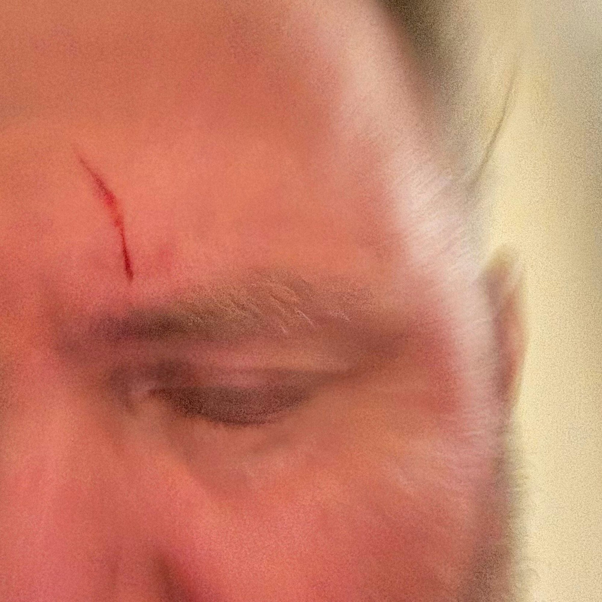 Foto von Stirn mit Wunde und Blut