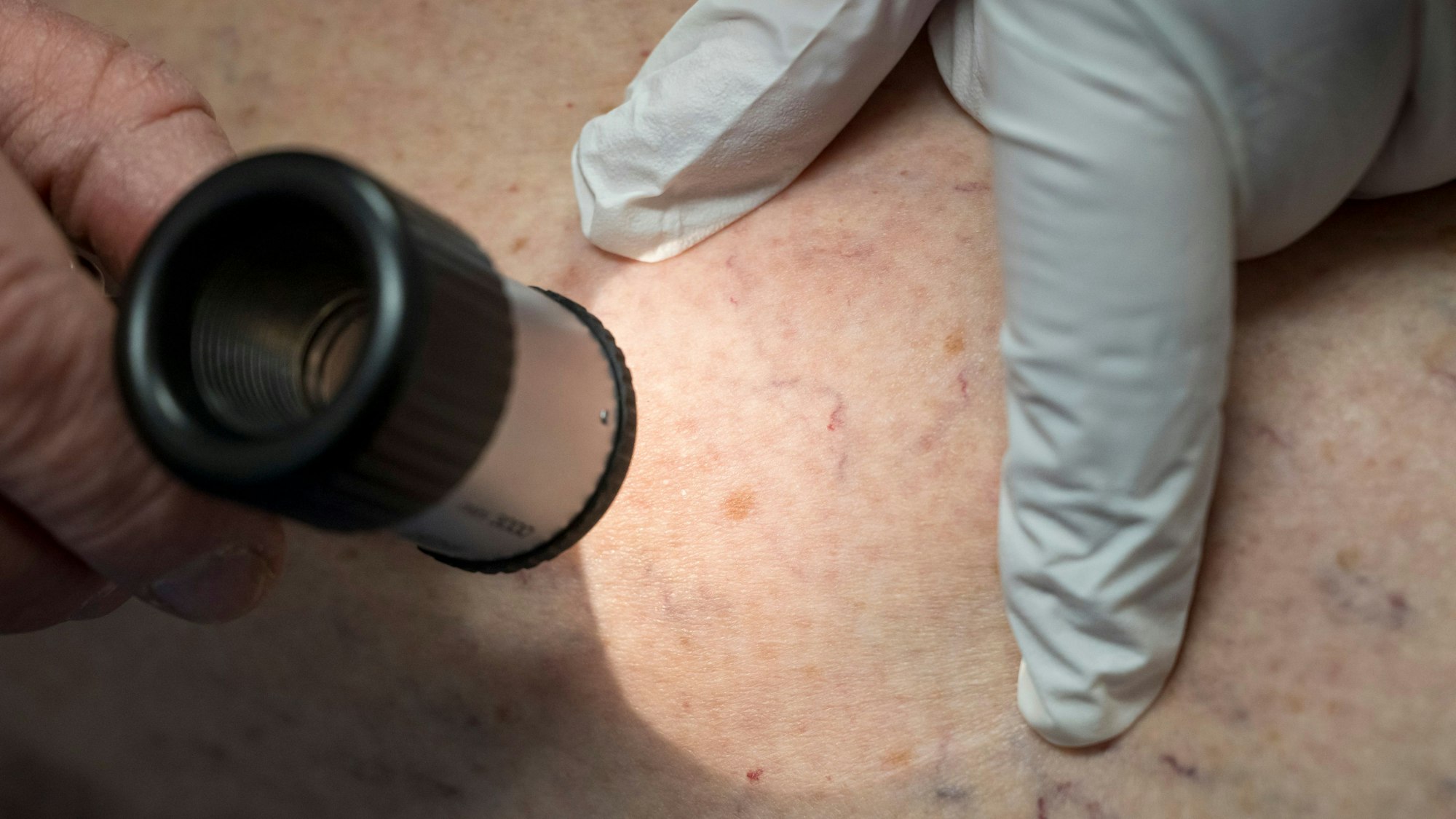 Bayern, München: Ein Arzt untersucht in der Praxis die Hautpartie eines Patienten.