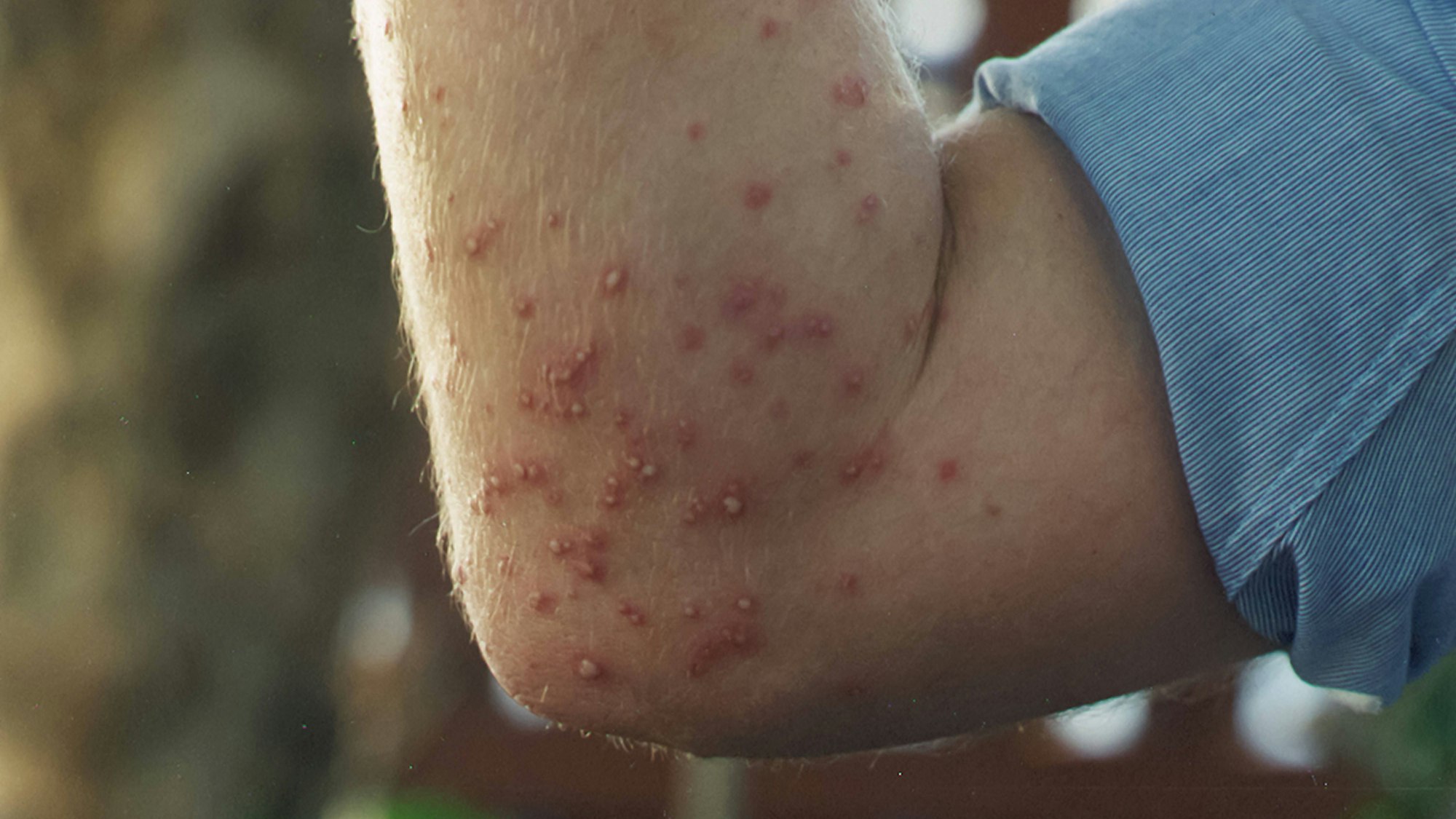 QUEENSLAND FIRE ANT TREATMENT, A supplied image obtained on Wednesday, October 2, 2024, shows a fire ant sting after 48 hours. Queensland police have been called in to force resistant property owners to submit to mandatory treatment for invasive fire ants. ACHTUNG: NUR REDAKTIONELLE NUTZUNG, KEINE ARCHIVIERUNG UND KEINE BUCHNUTZUNG AUSTRALIA PUBLICATIONxNOTxINxAUSxNZLxPNGxFIJxVANxSOLxTGA Copyright: xSUPPLIEDxBYxINVASIVExSPECIESxCOUNCILx 20241002112794707004