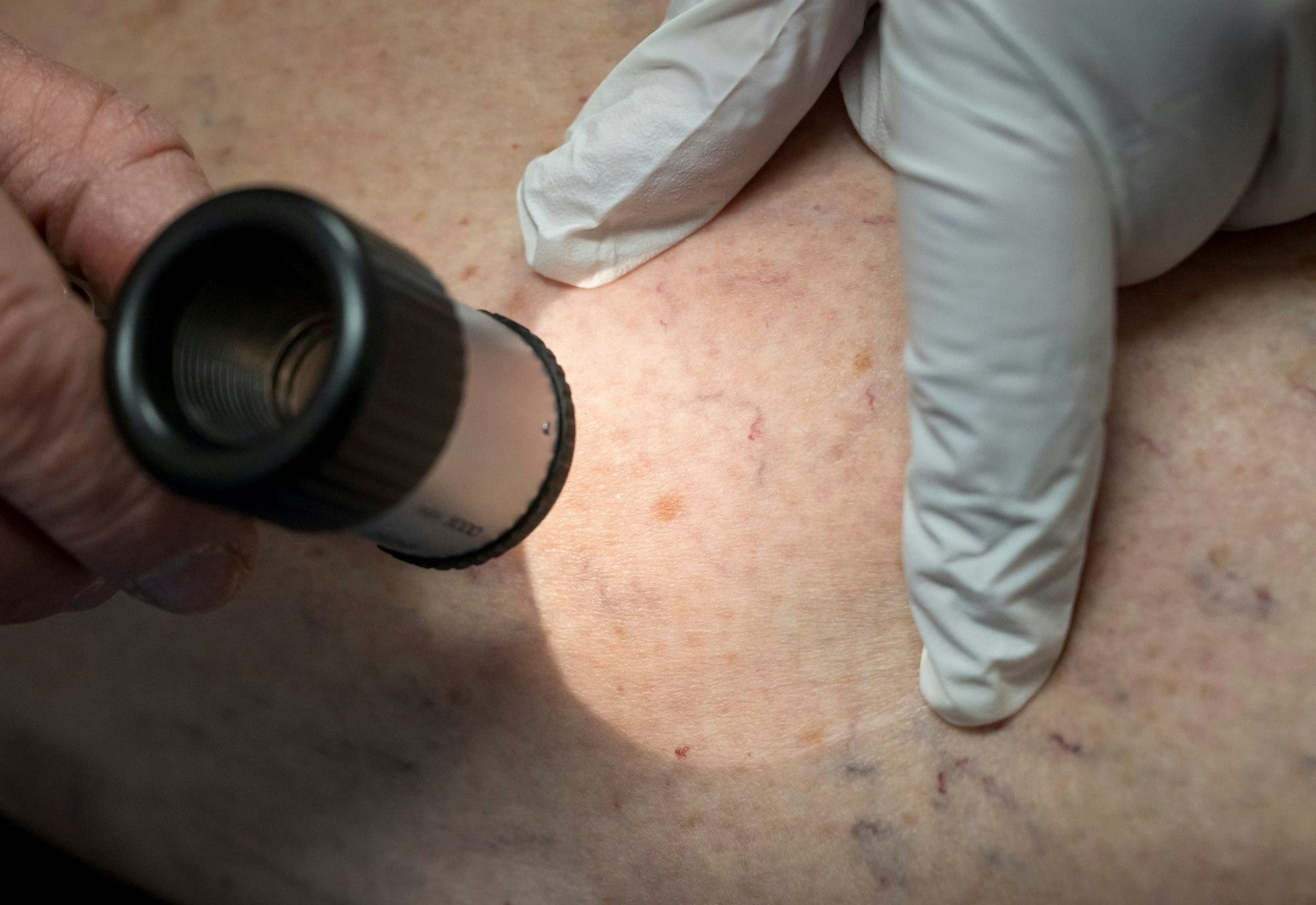 Die Zahl der Krankenhausbehandlungen von Hautkrebs stieg enorm an. (Symbolbild)