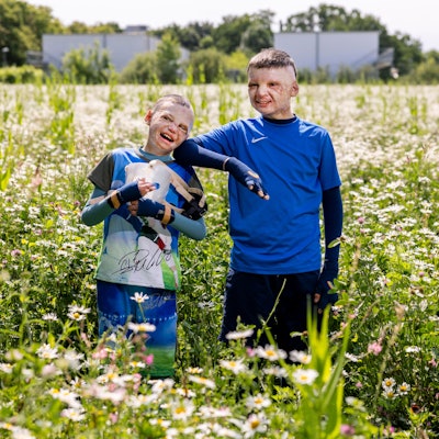 14.05.2025, Köln: Yurii und Yevhen aus der Ukraine wurden durch eine Explosion einer Erdölraffinerie in der Ukraine schwerst verbrannt und in der Uniklinik Köln behandelt.
Im Bild v.l.n.r. Yurii und Yevhen.
Foto: Michael Bause