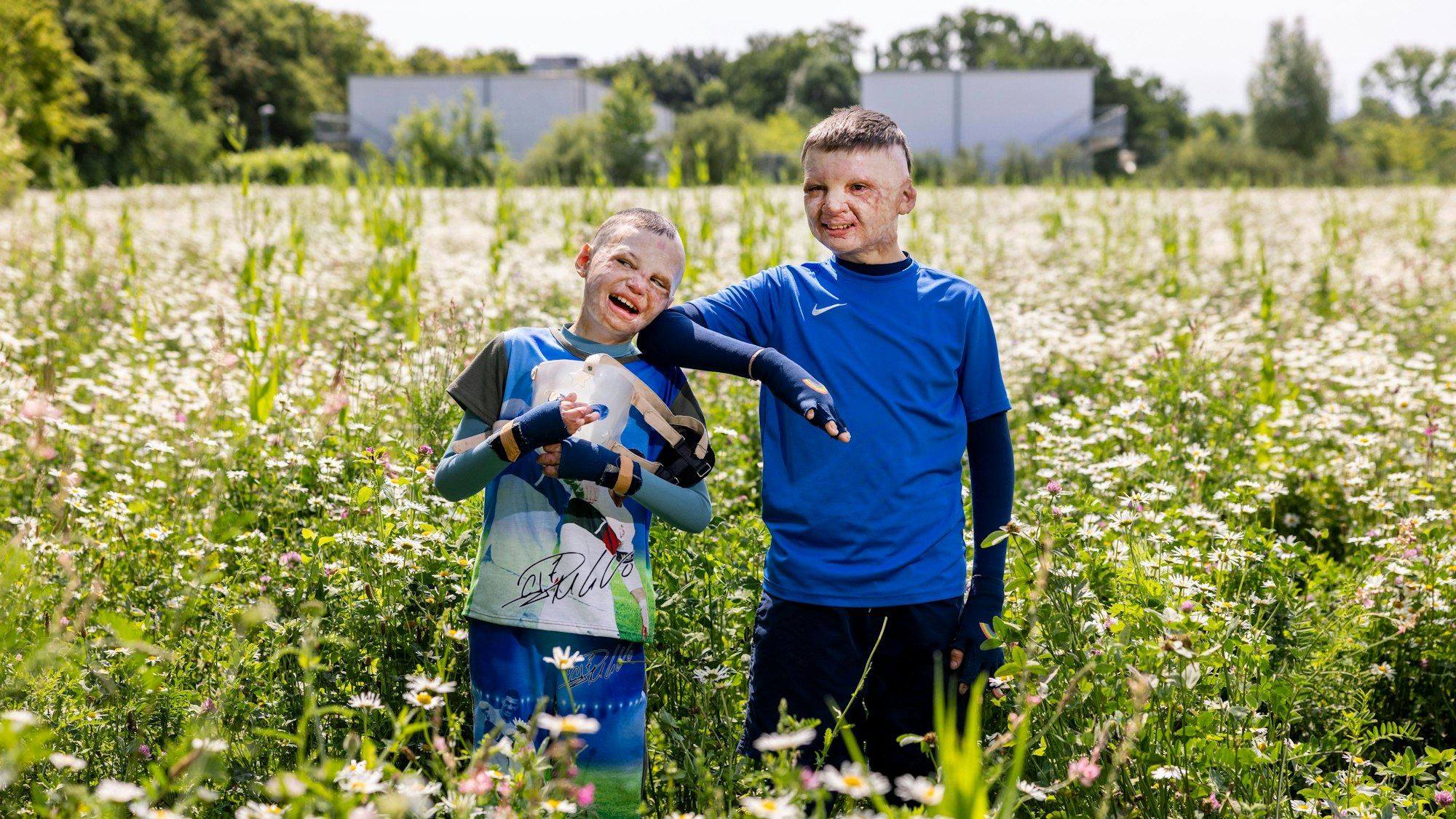 14.05.2025, Köln: Yurii und Yevhen aus der Ukraine wurden durch eine Explosion einer Erdölraffinerie in der Ukraine schwerst verbrannt und in der Uniklinik Köln behandelt.
Im Bild v.l.n.r. Yurii und Yevhen.
Foto: Michael Bause