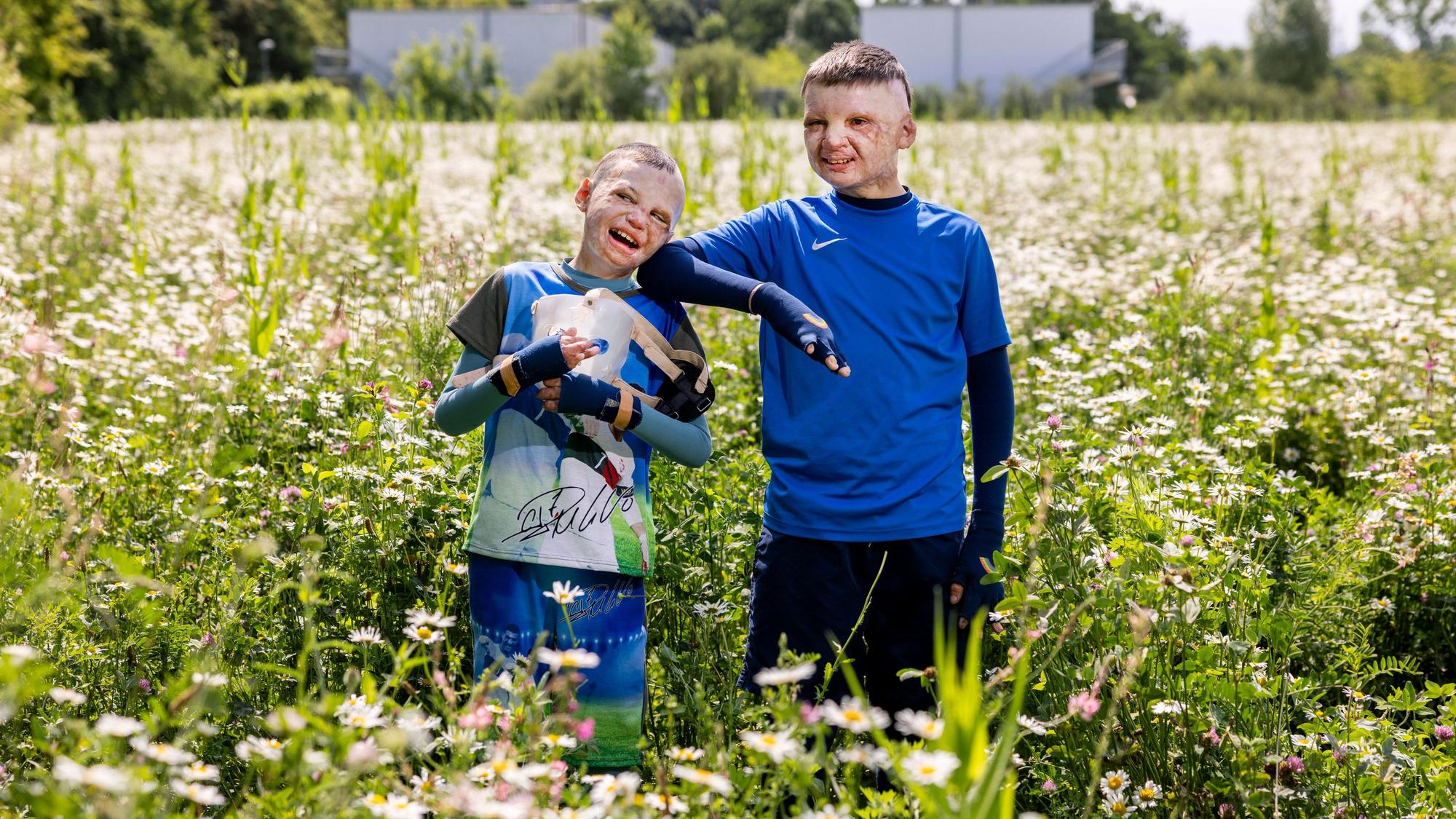 14.05.2025, Köln: Yurii und Yevhen aus der Ukraine wurden durch eine Explosion einer Erdölraffinerie in der Ukraine schwerst verbrannt und in der Uniklinik Köln behandelt.
Im Bild v.l.n.r. Yurii und Yevhen.
Foto: Michael Bause