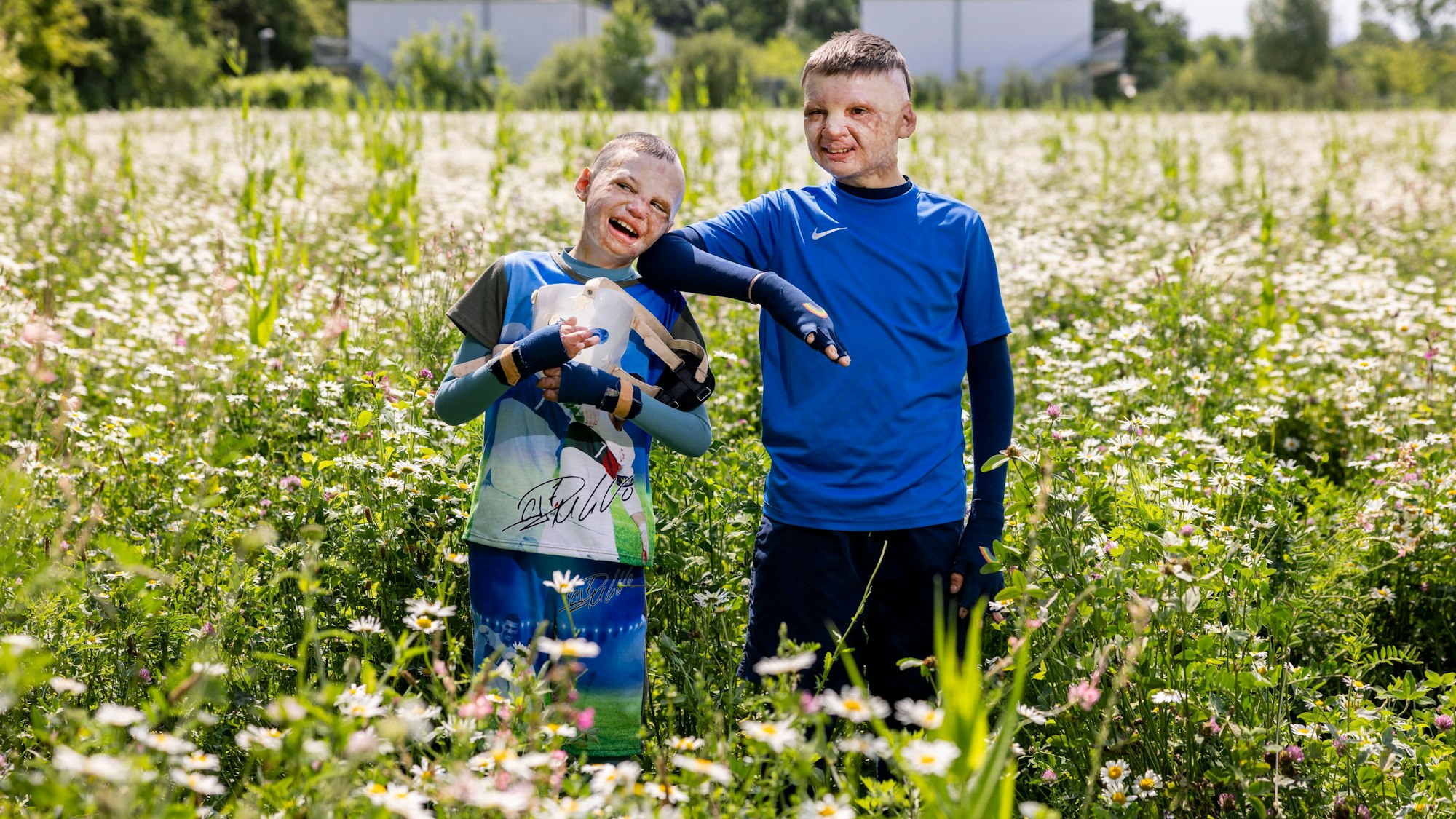14.05.2025, Köln: Yurii und Yevhen aus der Ukraine wurden durch eine Explosion einer Erdölraffinerie in der Ukraine schwerst verbrannt und in der Uniklinik Köln behandelt.
Im Bild v.l.n.r. Yurii und Yevhen.
Foto: Michael Bause