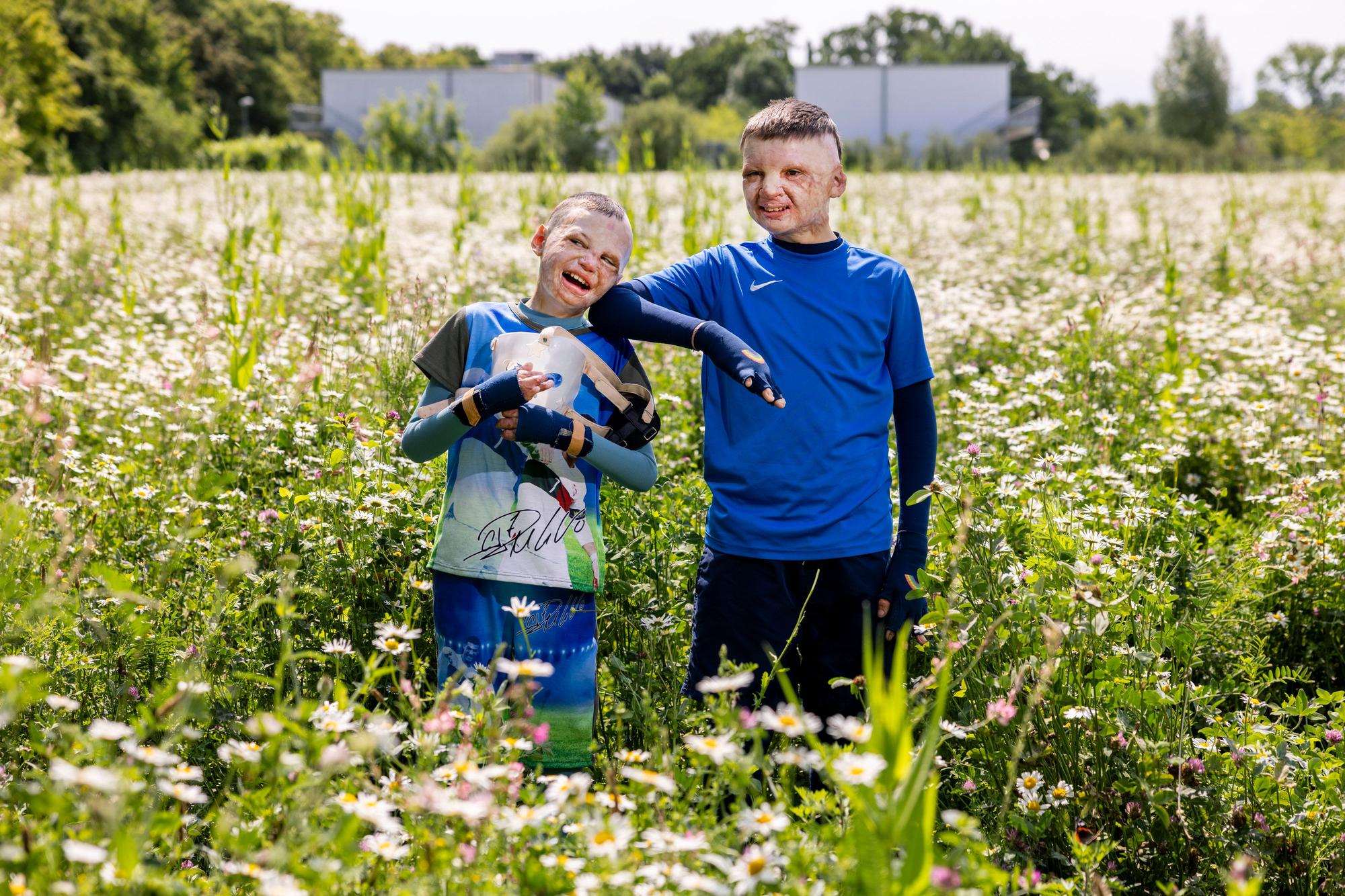 14.05.2025, Köln: Yurii und Yevhen aus der Ukraine wurden durch eine Explosion einer Erdölraffinerie in der Ukraine schwerst verbrannt und in der Uniklinik Köln behandelt.
Im Bild v.l.n.r. Yurii und Yevhen.