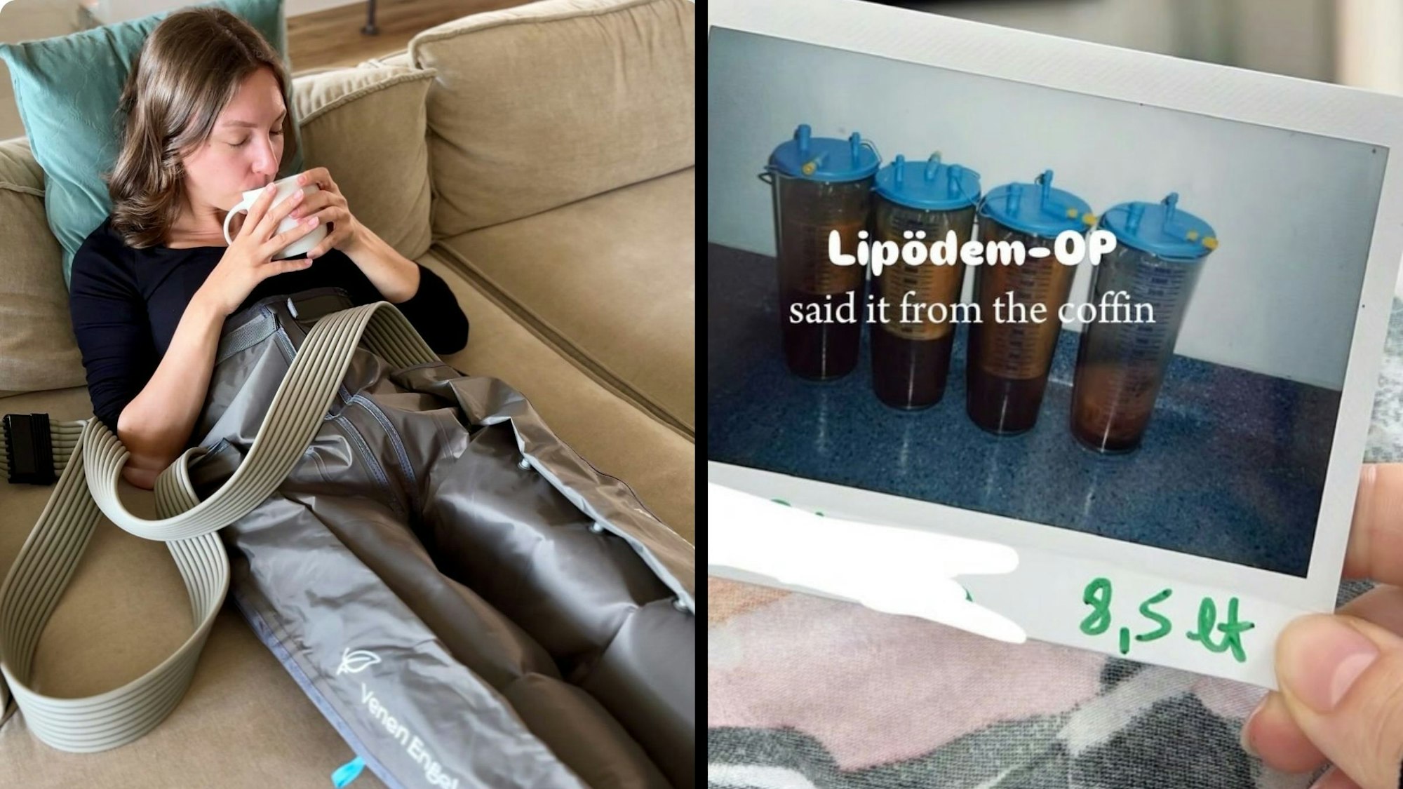 Auf dem Foto links ist Anna Stamm während einer manuellen Lymphdrainage zu sehen. Das rechte Foto zeigt abgesaugtes Fett nach der zweiten OP von Anna, bei der Oberschenkel, Arme und Unterbauch abgesaugt wurden.