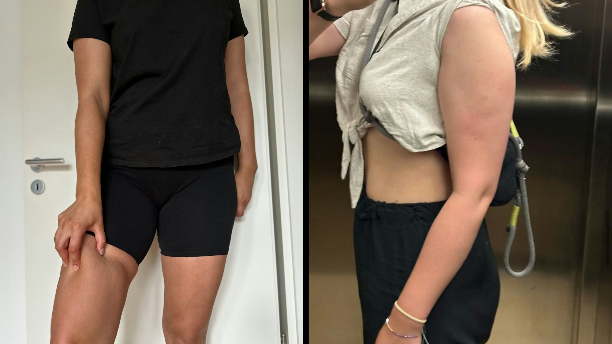 Cynthia R.s Beine und Arme vor der Lipödem-OP.