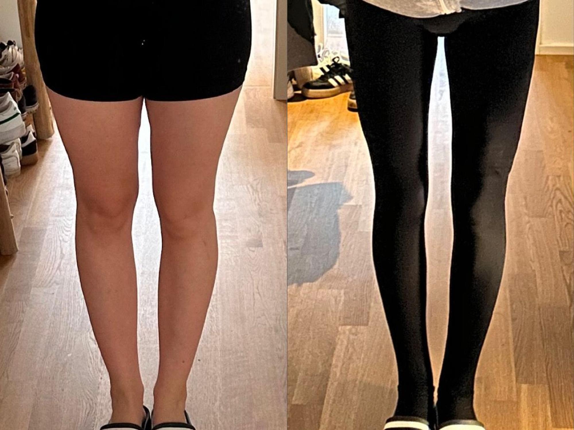 Ein Vorher-nachher-Vergleich von Cynthia R.s Beinen. Links vor der Liposuktion und rechts nach der Behandlung.