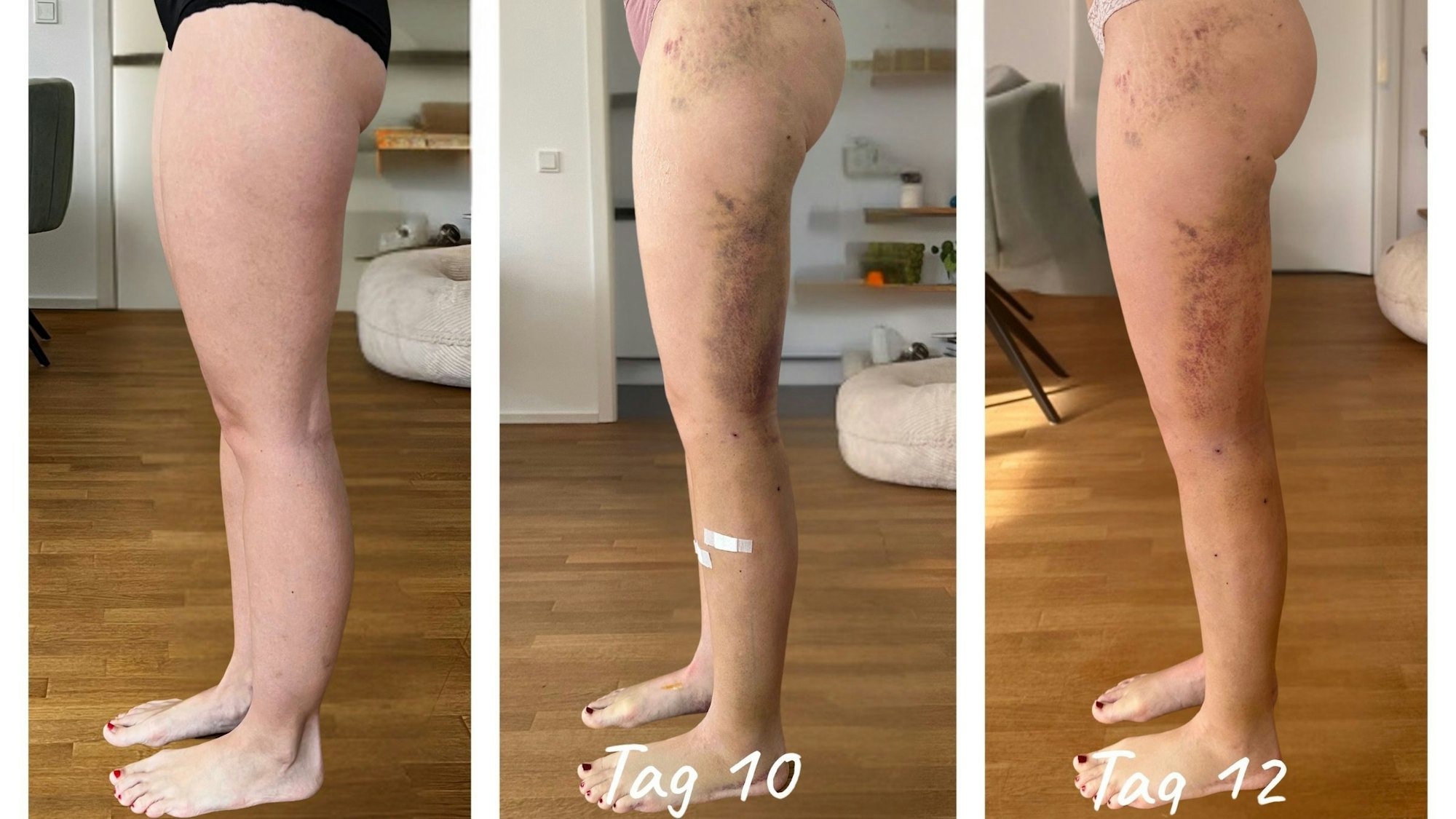 Links ist ein Foto vor einer Lipödem-OP, in der Mitte und rechts kurz nach einer Behandlung.