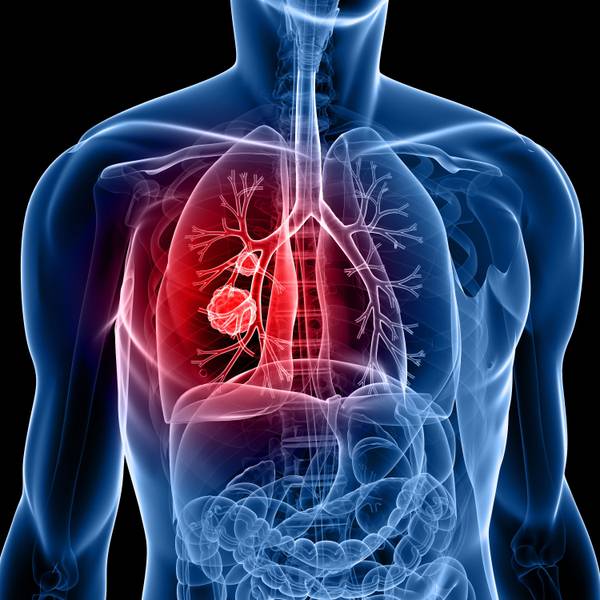Ein Tumor in der Lunge eines Menschen.