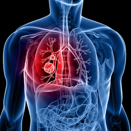 Ein Tumor in der Lunge eines Menschen.