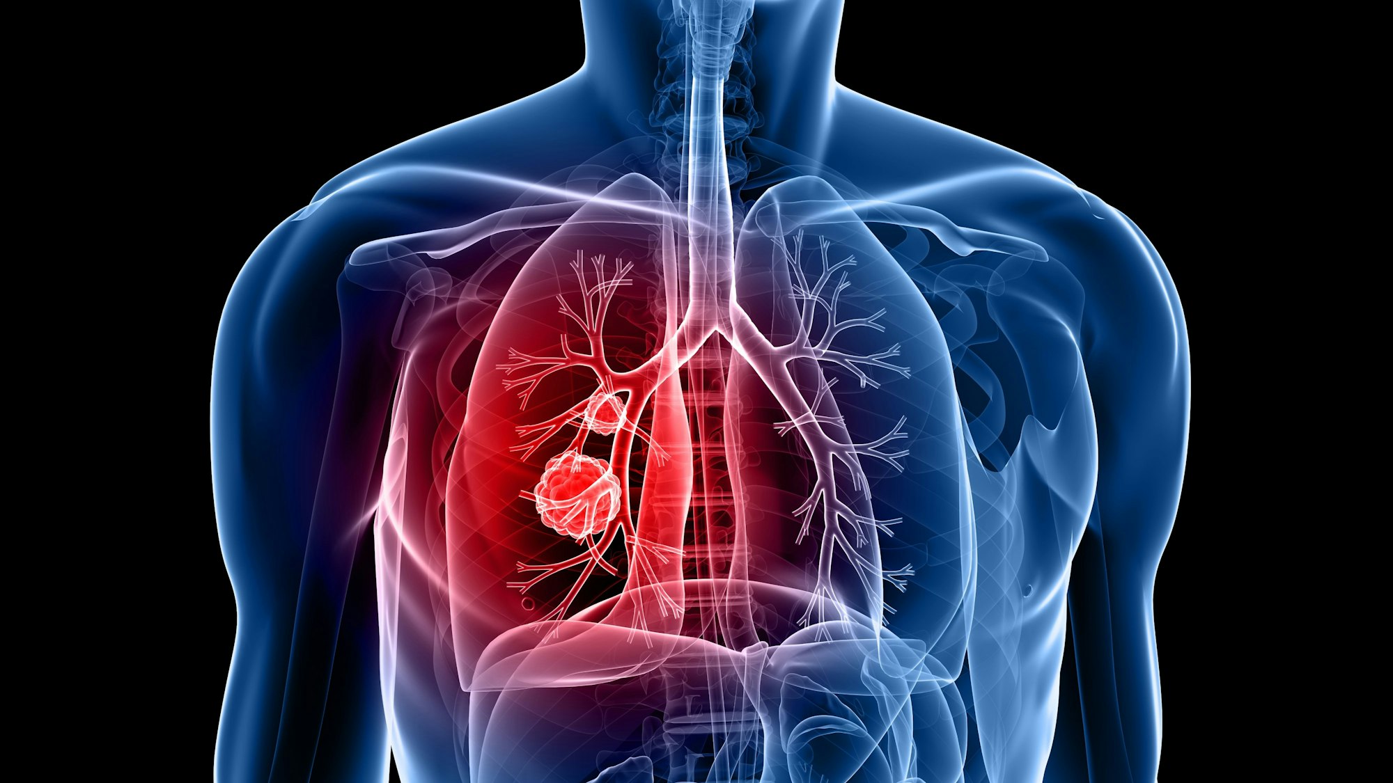 Ein Tumor in der Lunge eines Menschen.