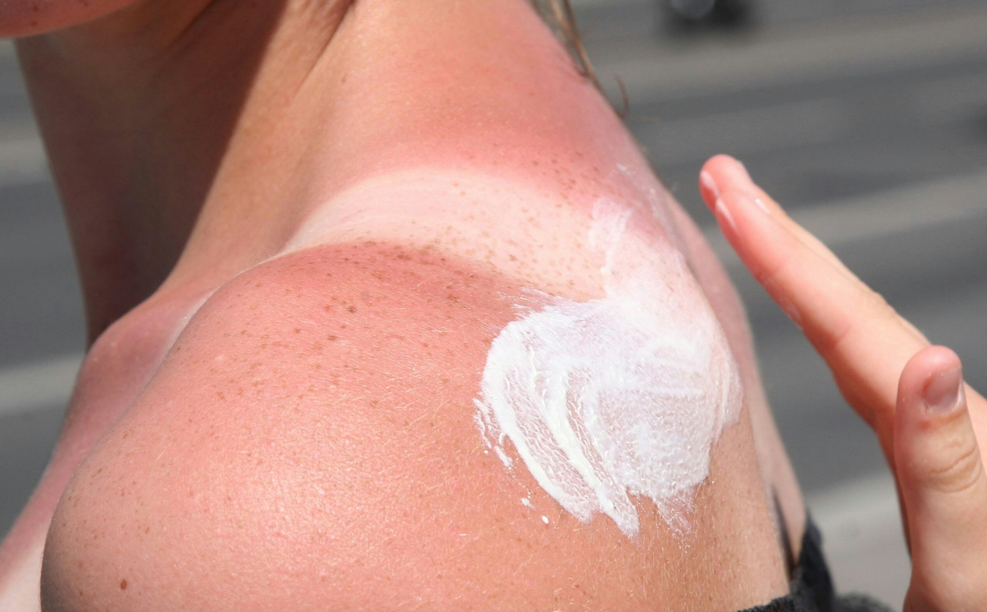 Bei Sonnenbrand ist Hautpflege gefragt: Feuchtigkeitsspendende Lotionen mit Aloe vera helfen der geschädigten Haut.