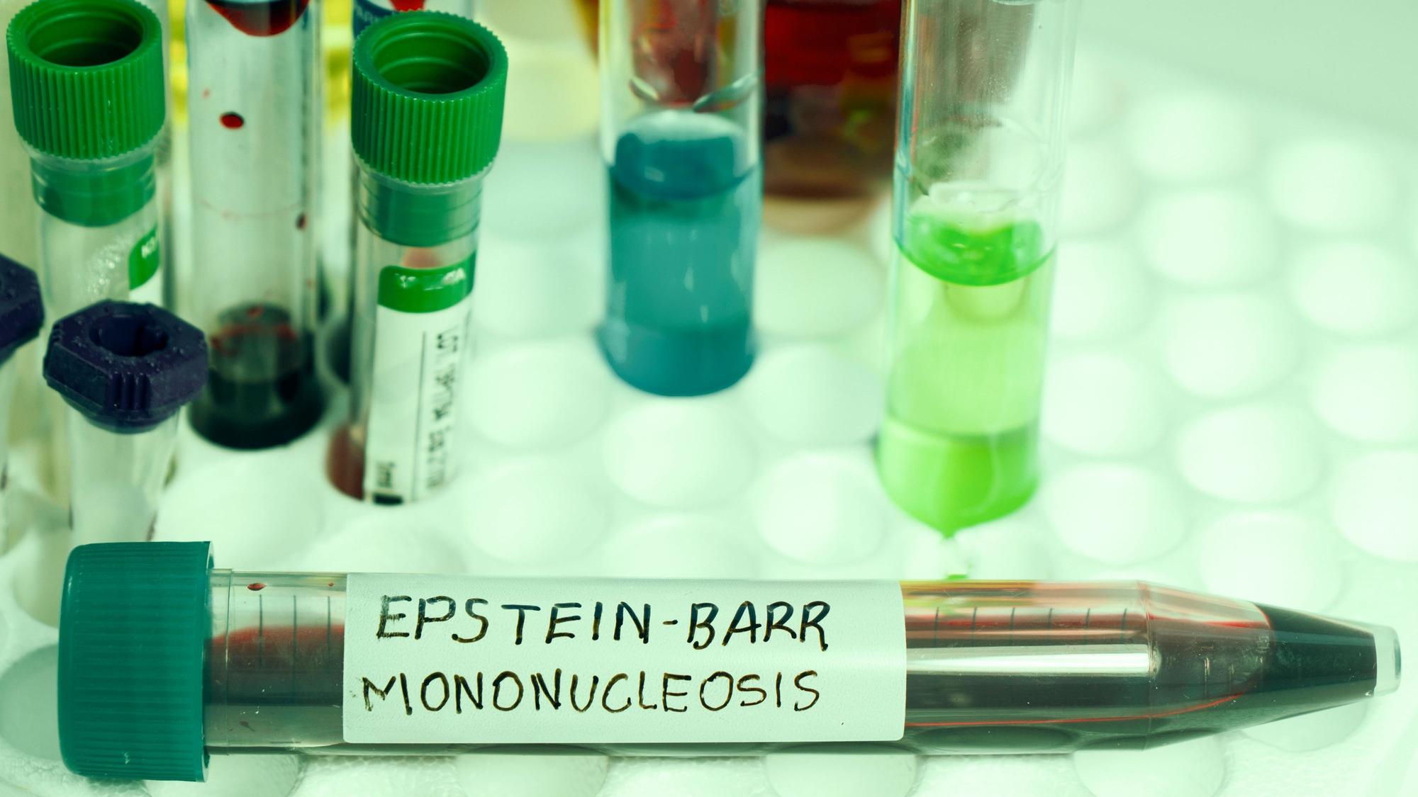 Blutprobe zur Analyse auf Epstein-Barr-Virus. Eine Infektion, die als möglicher Auslöser für Multiple Sklerose gilt.
