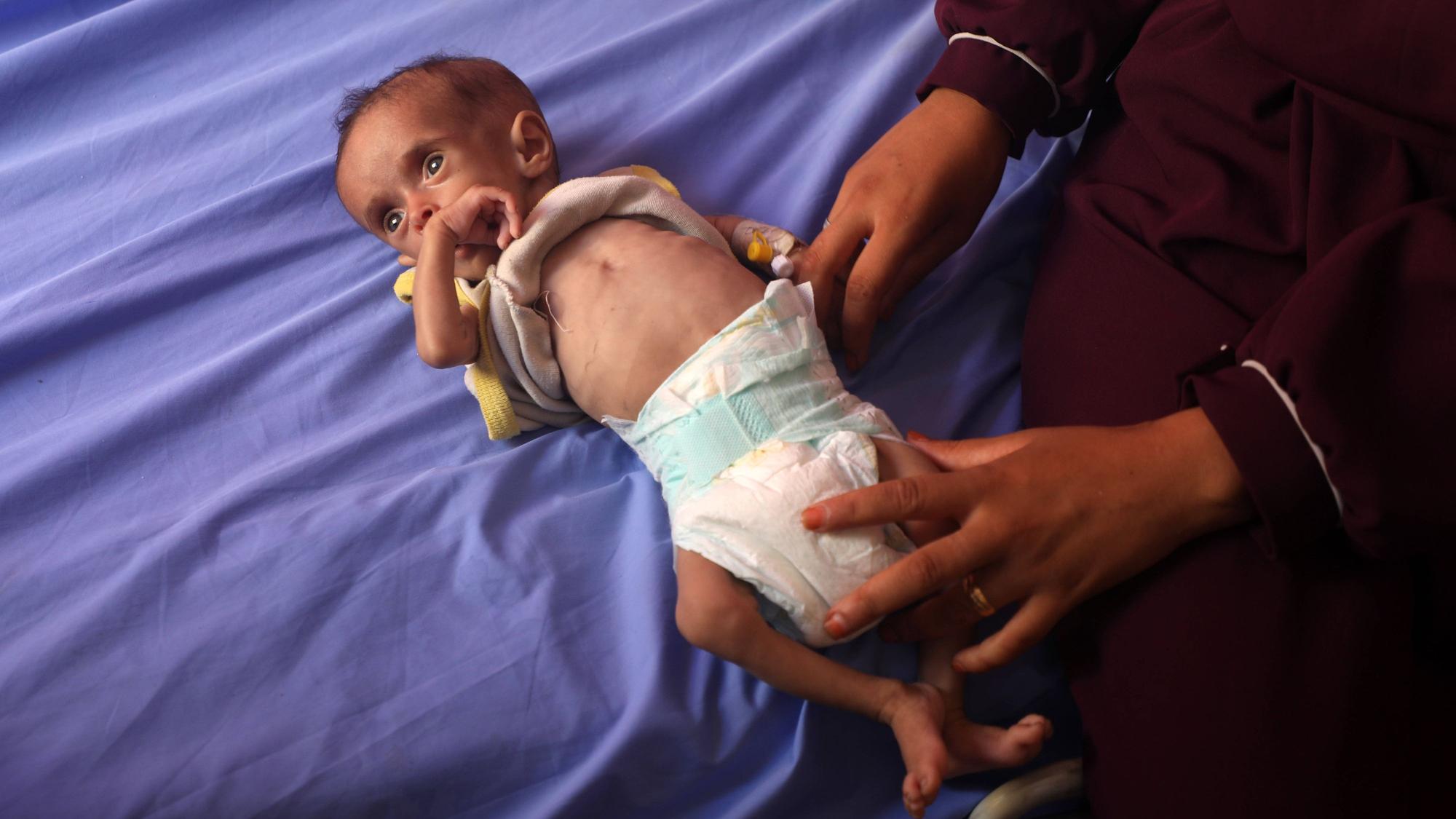 Ein unterernährtes Kleinkind wird am 23. Juli im Al-Rantisi Hospital im Gazastreifen behandelt.