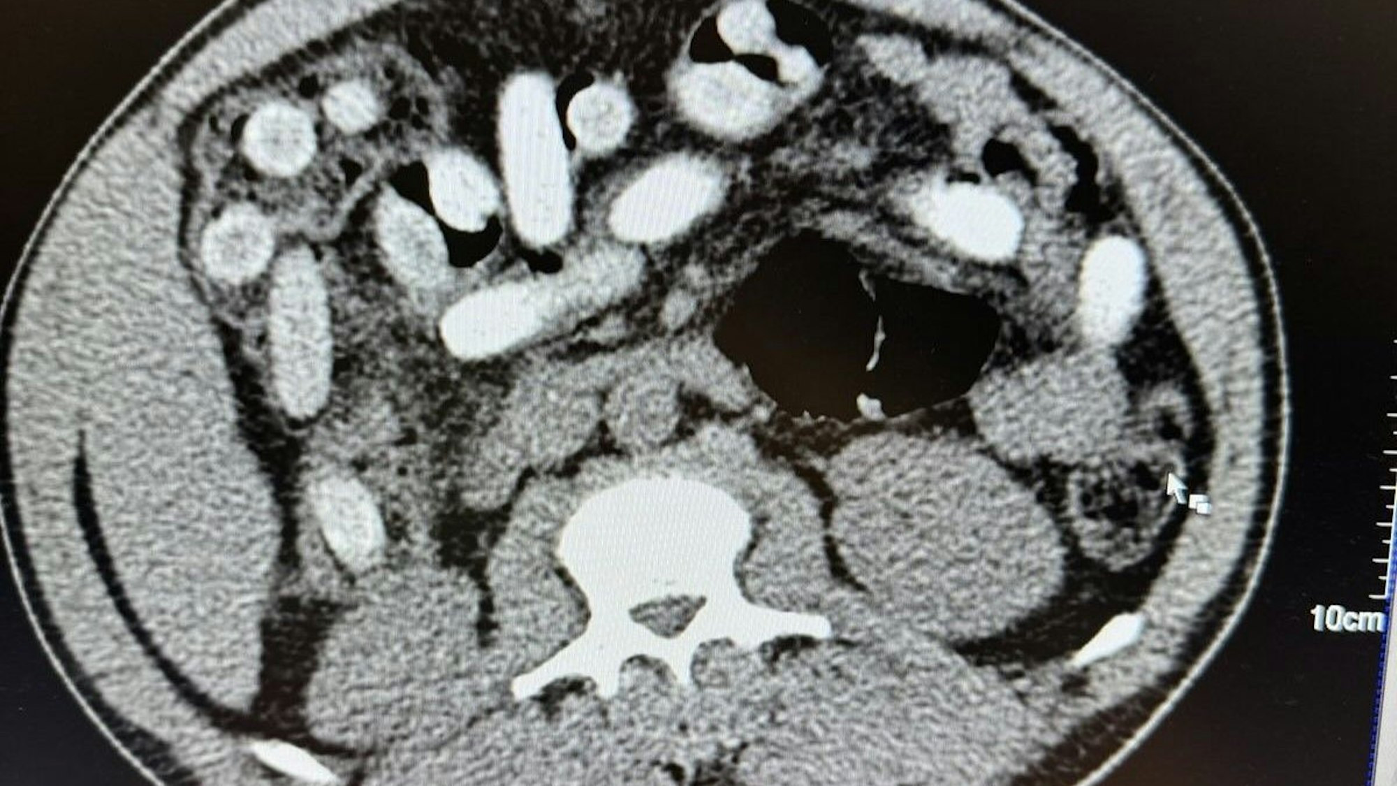 Die Polizei veranlasste ein Röntgenbild vom Magen des Verdächtigen.